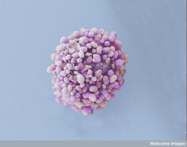 Understanding Genetic Differences Between  Breast Cancer Tumors Is Key to Better Treatment